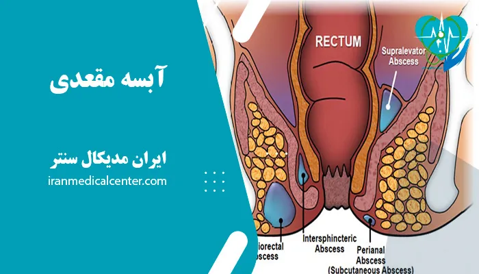 َآبسه مقعدی