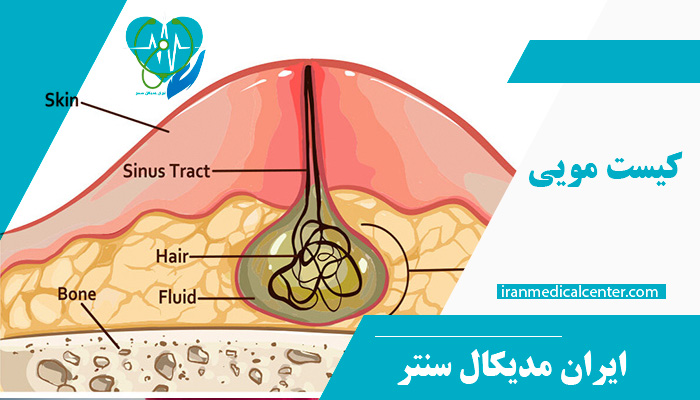 کیست مویی