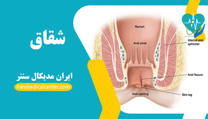 شقاق