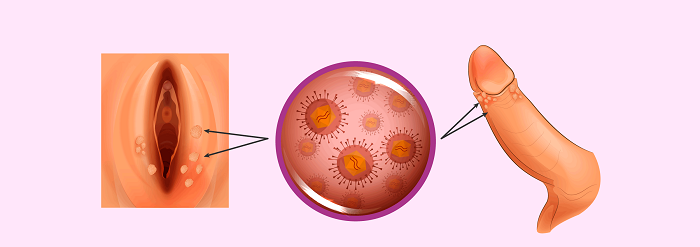 درمان زگیل تناسلی در اهواز کیانپارس هزینه درمان لیزر و عکس تشخیص