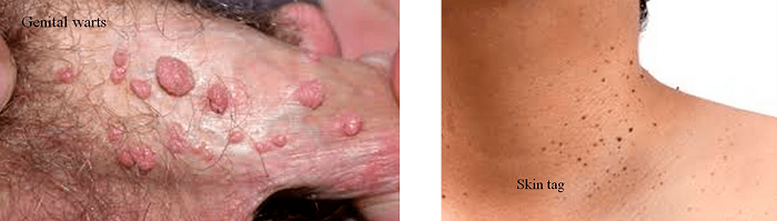 زگیل تناسلی تیپ ۱۱