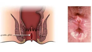 بهترین کلینیک درمان شقاق مقعدی در تهران | بهترین مرکز درمان شقاق در تهران