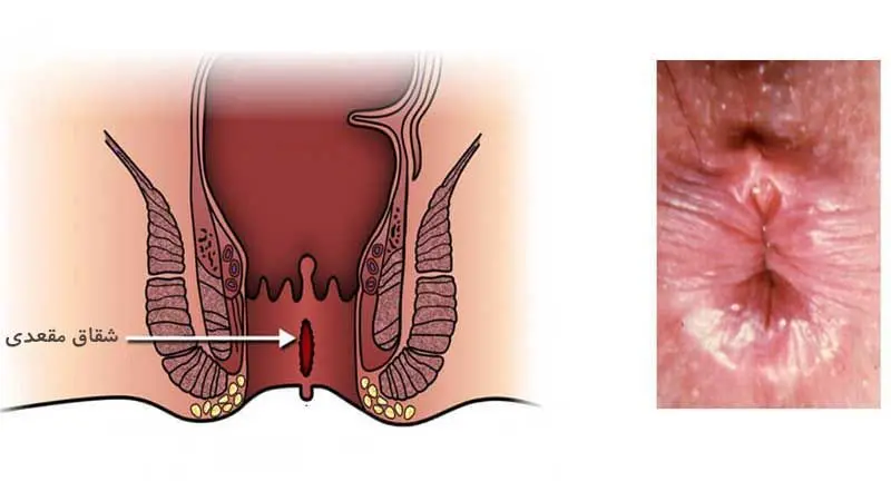 بهترین کلینیک درمان شقاق مقعدی در تهران | بهترین مرکز درمان شقاق در تهران