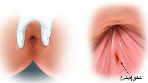 بهترین کلینیک درمان شقاق (فیشر) در شرق تهران