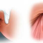 چرا درمان شقاق در کلینیک ایران مدیکال سنتر