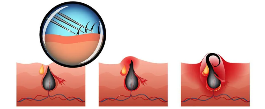 بهترین کلینیک درمان موکیست پیلونیدال سینوس پیلونیدال غرب تهران