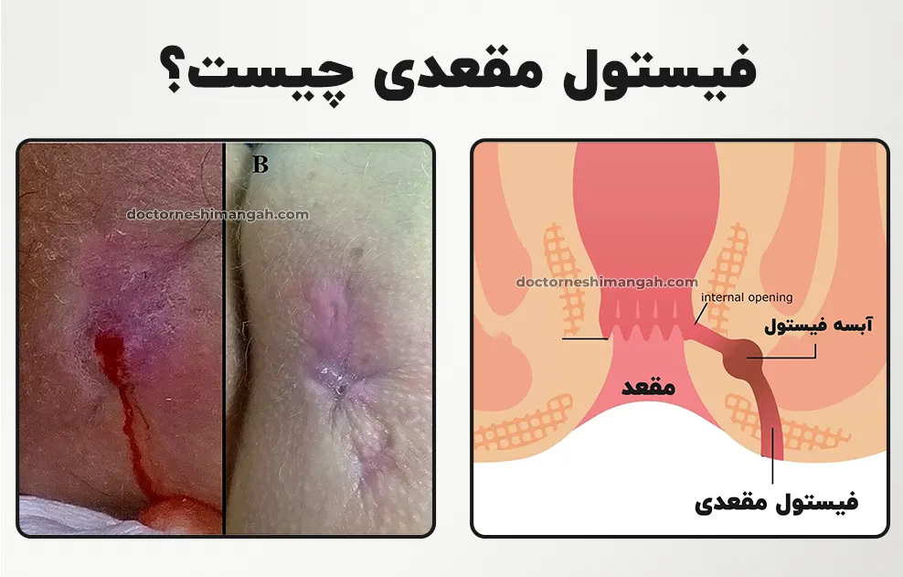 بهترین مرکز تخصصی درمان آبسه و فیستول در شرق تهران