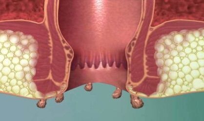 کلینیک ایران مدیکال سنتر | بهترین مرکز درمان زگیل تناسلی مقعدی جنوب تهران