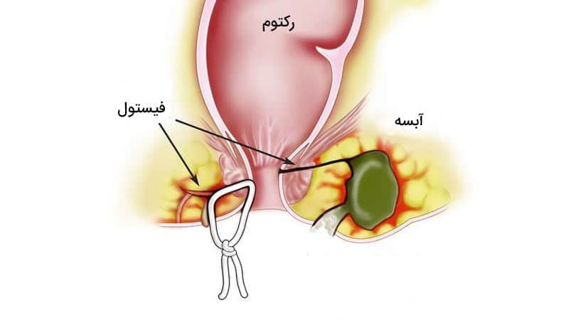 بهترین کلینیک درمان آبسه و فیستول در شمال تهران