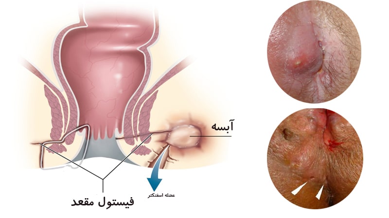 چرا درمان آبسه و فیستول را نباید ساده انگاشت؟