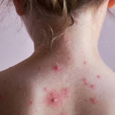 بهترین کلینیک درمان مولوسکوم جنوب تهران