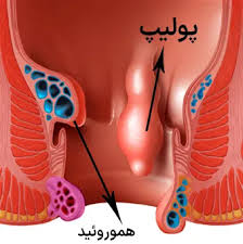 بهترین کلینیک مرکز درمان پولیپ رکتوم شمال تهران