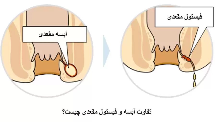 بهترین مرکز درمان آبسه و فیستول در جنوب تهران