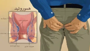 بهترین مرکز درمان هموروئید شرق تهران