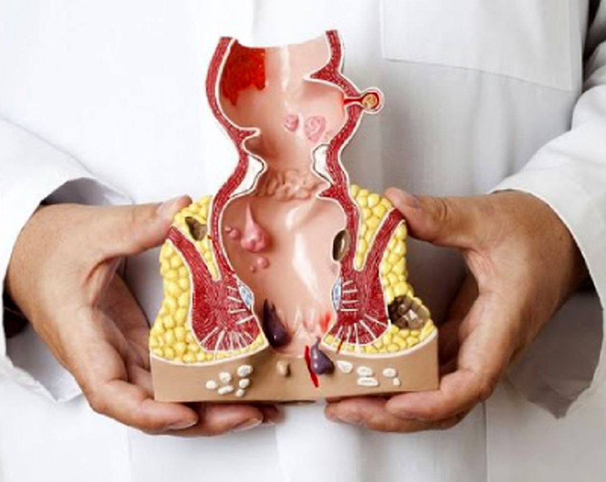 بهترین مرکز درمان همورویید شمال تهران | بهترین کلینیک درمان همروئید شمال تهران