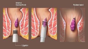 بهترین مرکز کلینیک درمان بواسیر شمال تهران