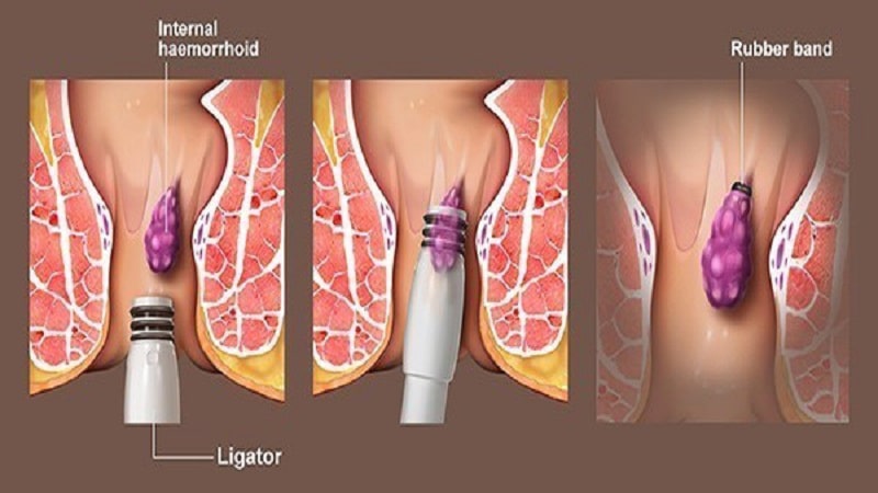 بهترین مرکز کلینیک درمان بواسیر شمال تهران