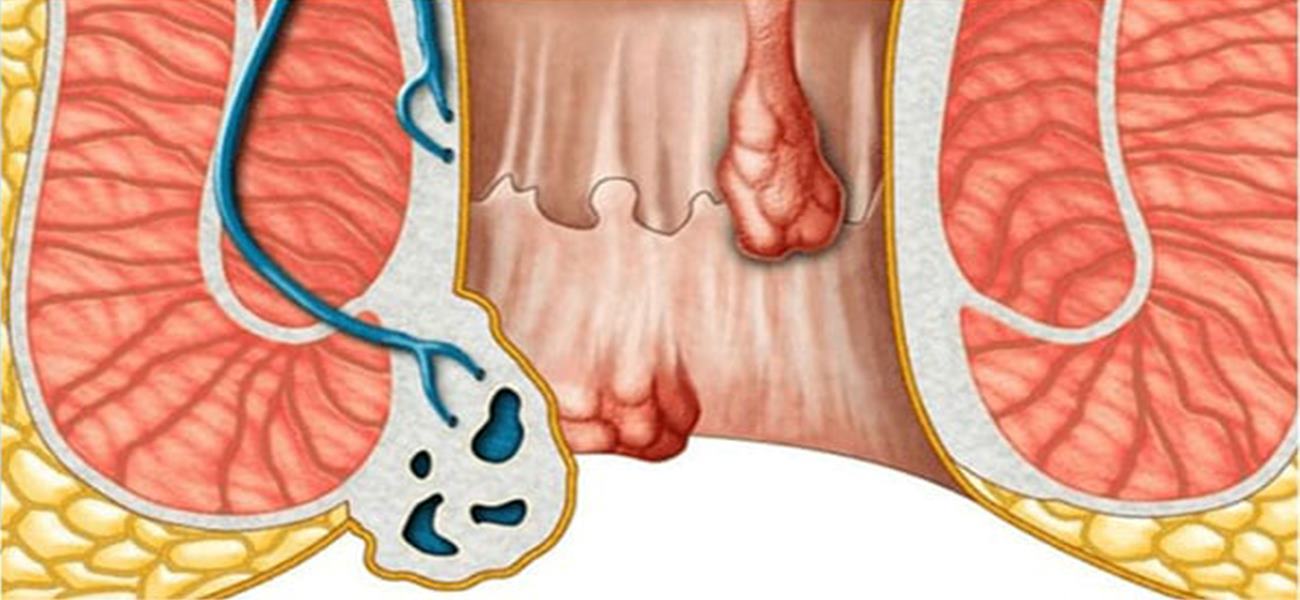 بهترین مرکز کلینیک درمان بواسیر غرب تهران